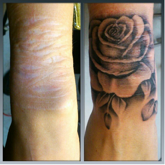 Tattoo Scar Cover-Ups